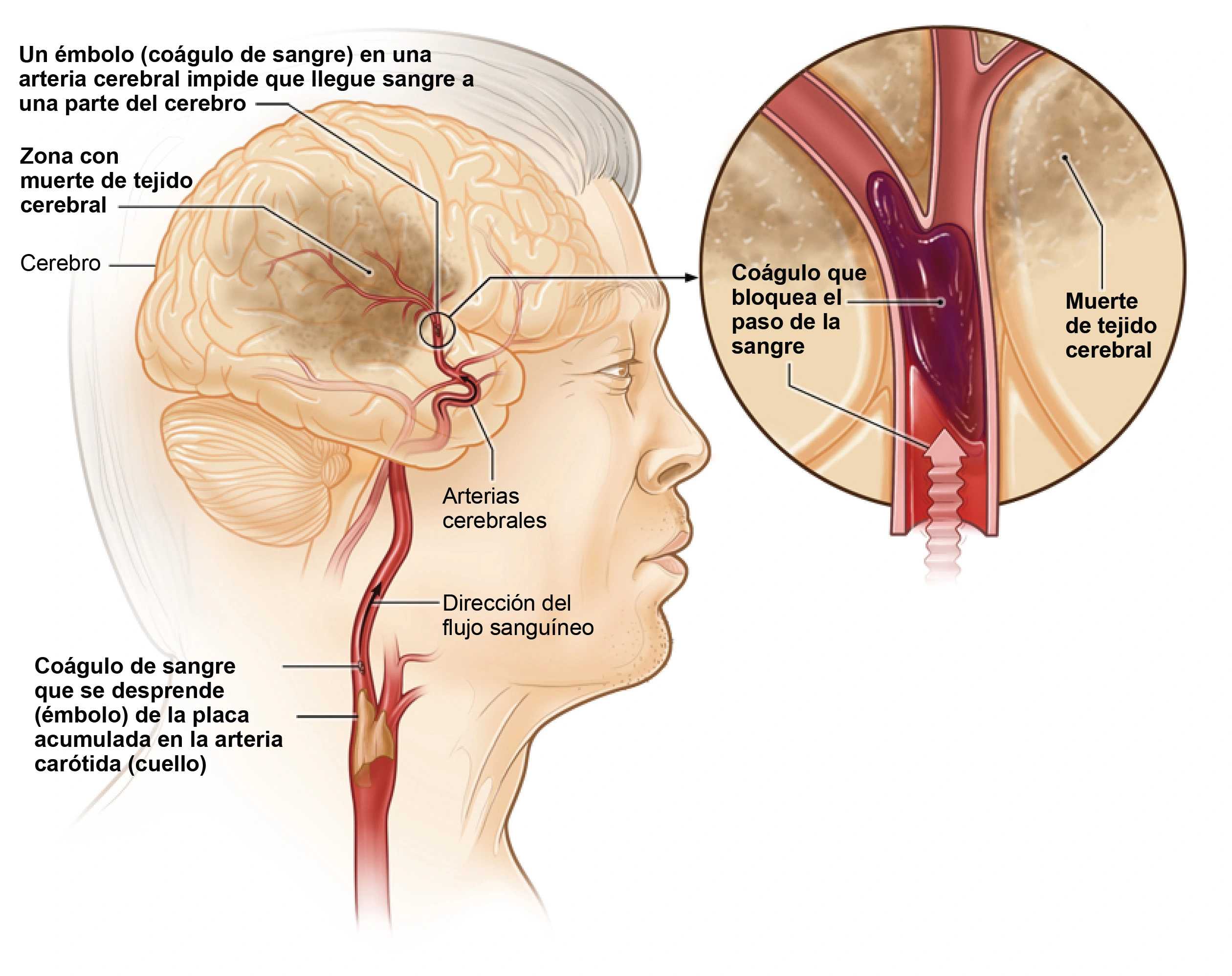 23-0583 NHLBI stroke_ischemic_Spanish_dev2_0.webp