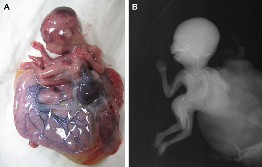 A-A-fetus-with-body-stalk-anomaly-and-a-malformed-umbilical-cord-arrows-B-X-ray.jpg