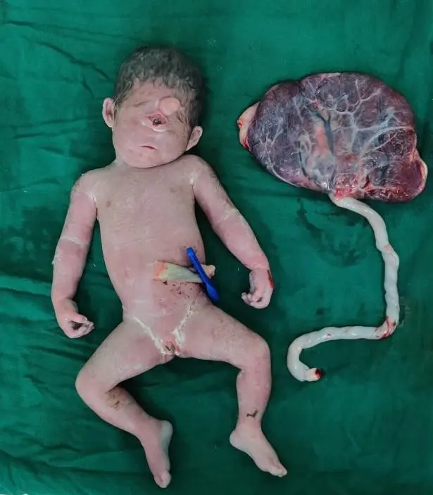 Anomalous-baby-with-normal-placenta.webp