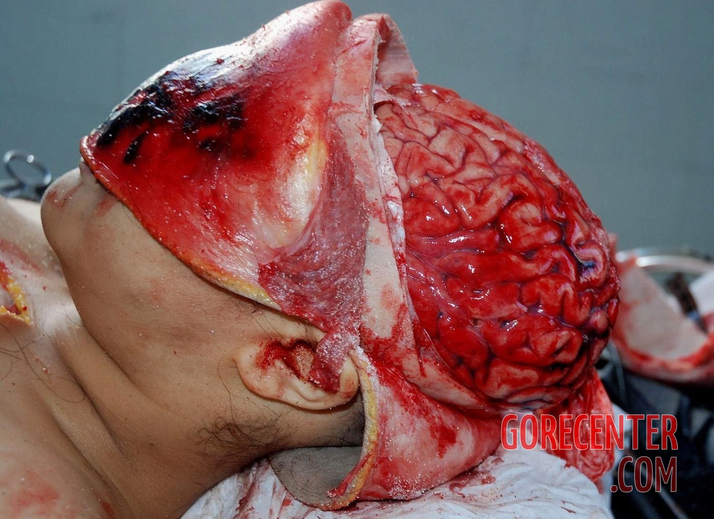 Autopsy-of-brain-after-stroke-4.jpg