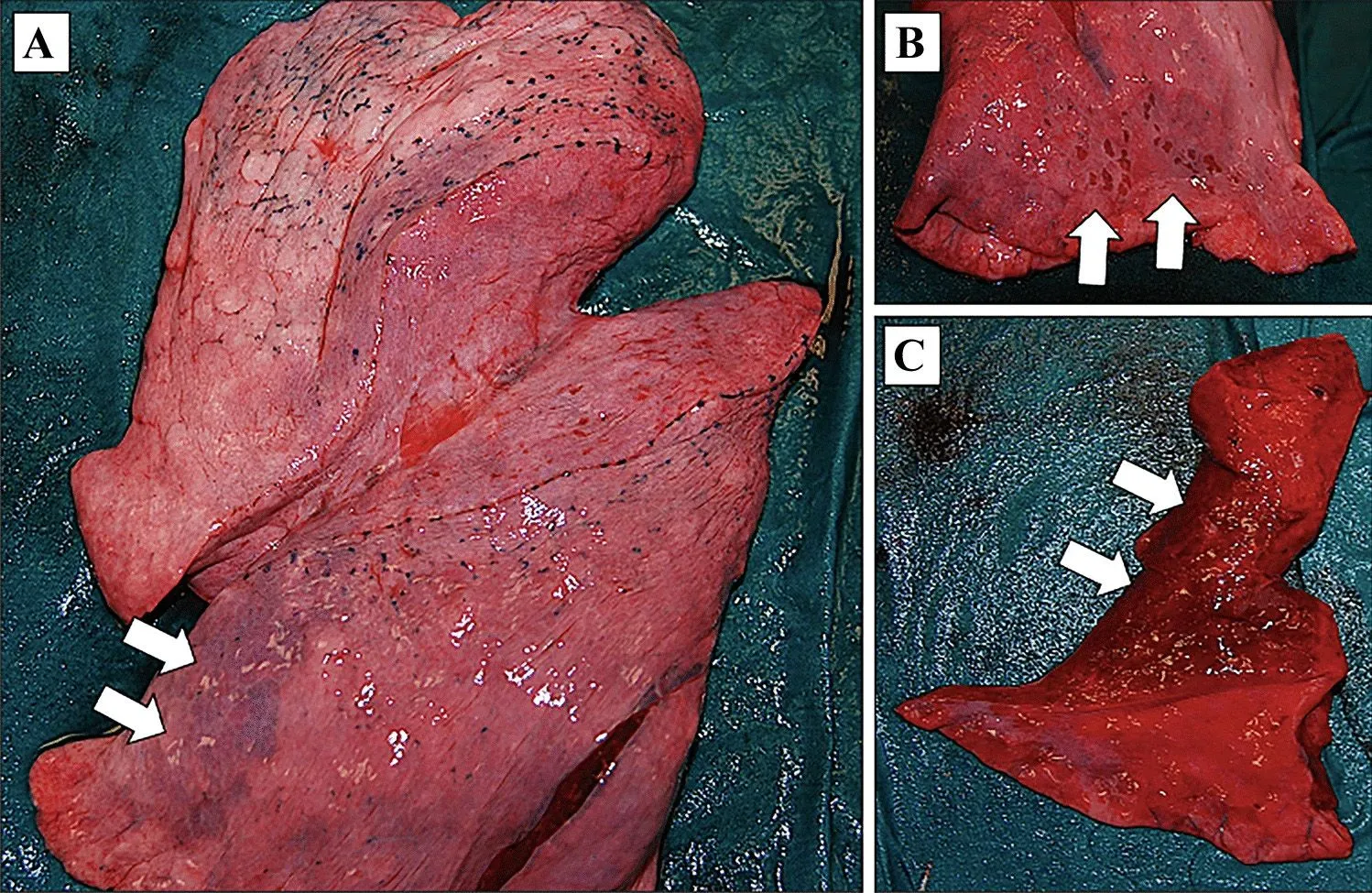 Blast effects on the lung.webp