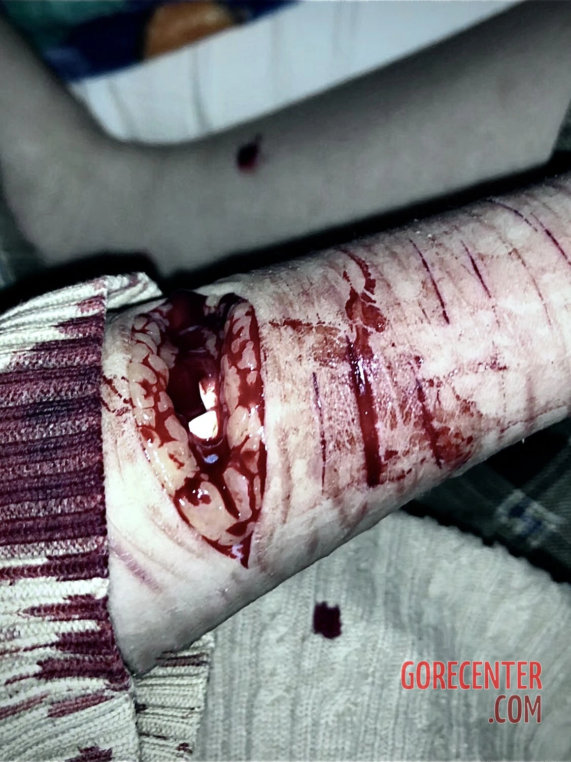 Cut-to-the-bone-on-teenagers-forearm-1.webp