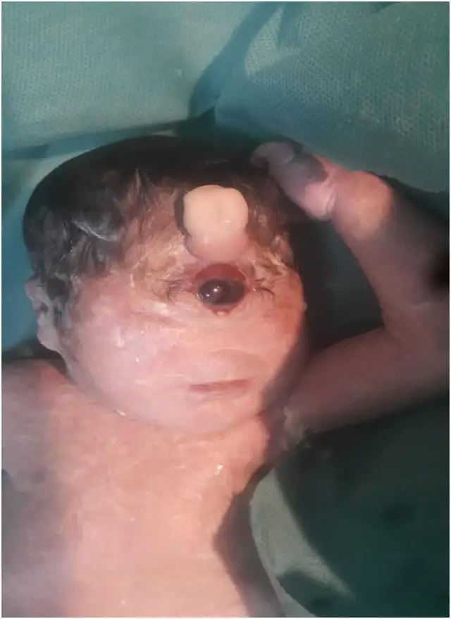 cyclopia-in-a-newborn-girl-born-at-7-months-gestation-she-v0-jf6b022ba8i91.webp