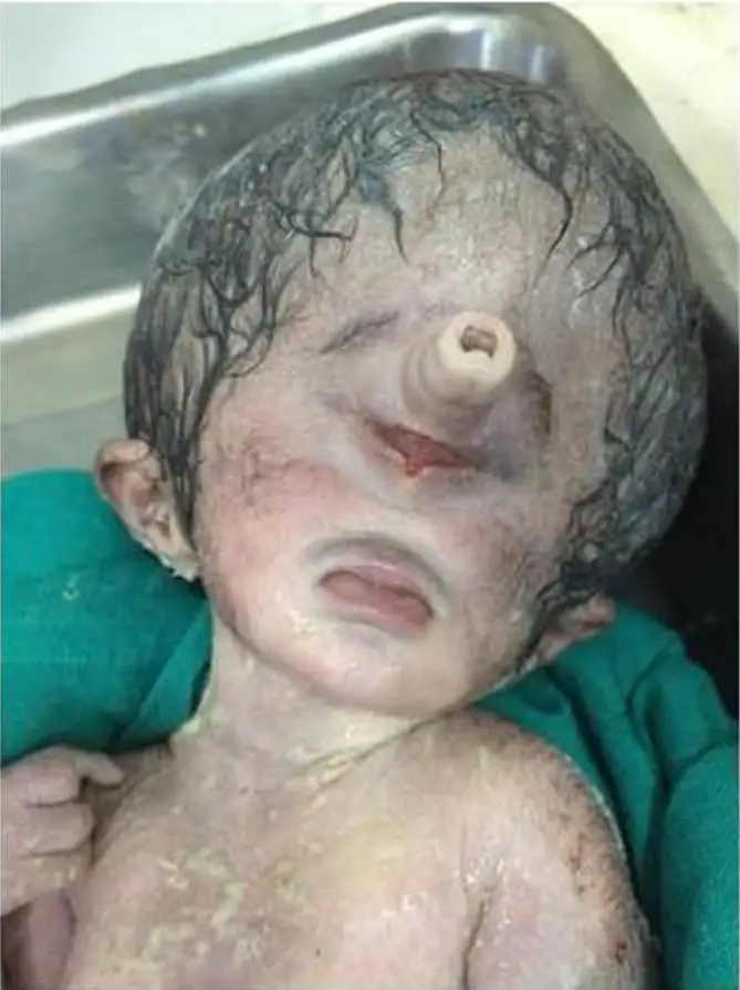 cyclopia-is-a-rare-condition-that-causes-a-child-to-be-born-v0-f7zwutn9ry9d1.webp