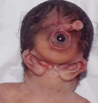 cyclopia-is-a-rare-congenital-disorder-characterized-by-v0-fju7leuoggya1.webp