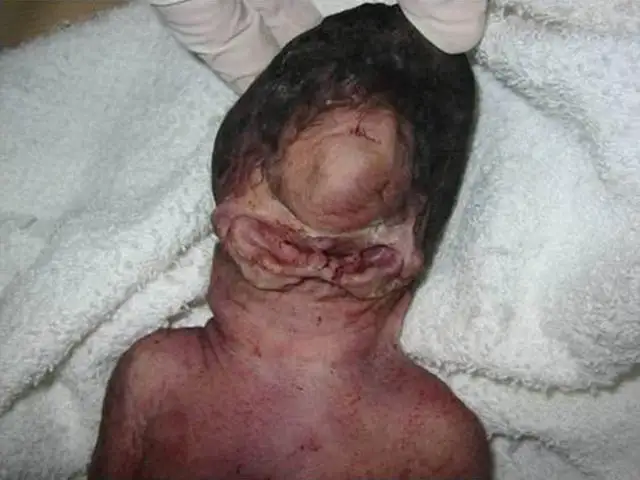 cyclopia-is-a-rare-congenital-disorder-characterized-by-v0-s1xjucuoggya1.webp