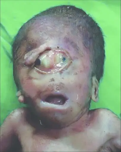 cyclopia-usually-characterized-by-a-victim-having-one-eye-v0-m8aw6k58jlqa1.webp