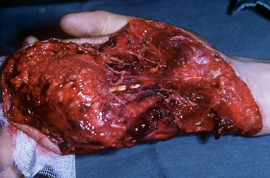 degloving-injury-mike-devlinscience-photo-library.jpg