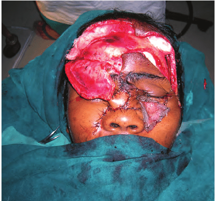 Intra-operative-picture-showing-canthopexy-harvested-nasolabial-flap-and-forehead-flap.png