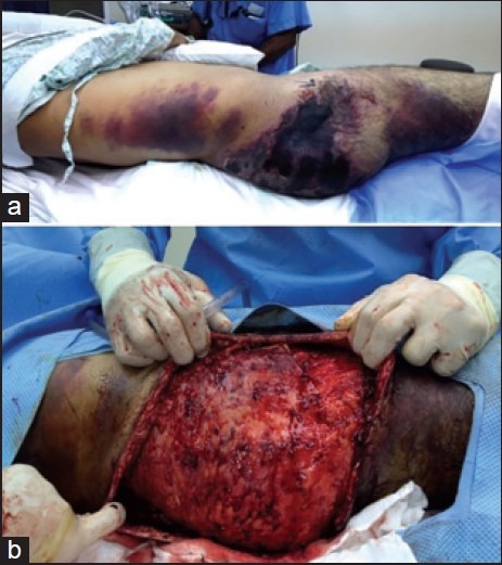 Major-degloving-injury-in-a-patient-with-severe-pelvic-injury-that-was-diagnosed-late-a.jpg