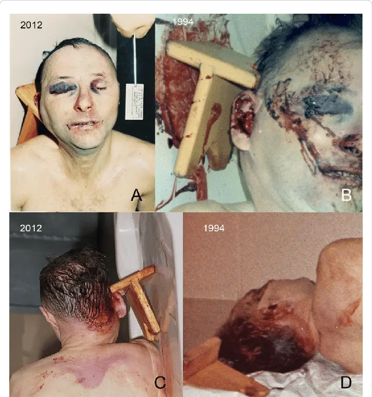 Other-autopsy-images-showing-the-extraordinary-swelling-on-the-right-side-of-the-victims.webp