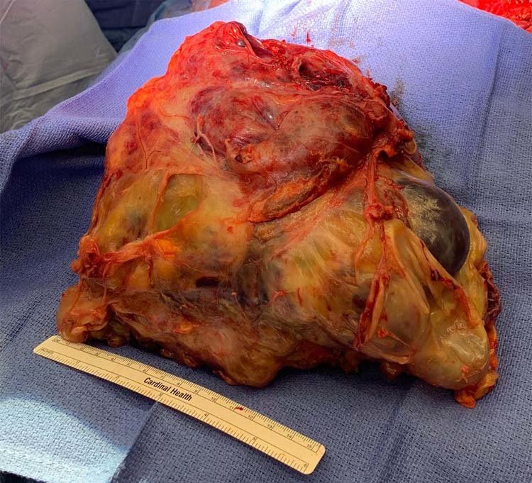 Tumor-specimen-Final-pathology-demonstrated-a-mixed-GCT-with-mostly-teratoma-Weight.jpg