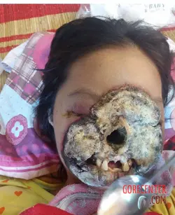 Young-woman-has-her-face-destroyed-by-bacterial-infection-1.webp