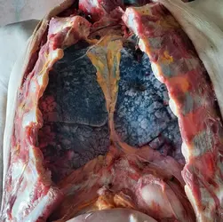 Autopsy-photo-of-smoker-lungs-768x767.webp