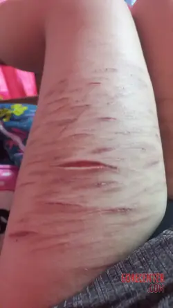 13-year-old-girl-cuts-herself-on-thigh-arm-and-breast-2.webp