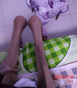 MIX-Extreme-cases-of-anorexia-22.jpg