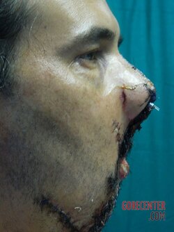 Dude-with-part-of-his-face-blown-off-undergoes-surgery-57.jpg