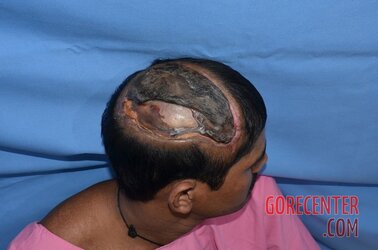 Auto-transplantation-of-skin-on-head-2.jpeg