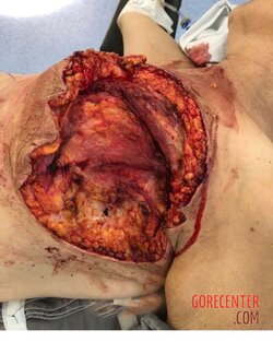 Breast-cancer-surgery-in-extreme-stage-3.jpeg