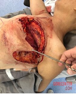 Breast-cancer-surgery-in-extreme-stage-4.jpeg