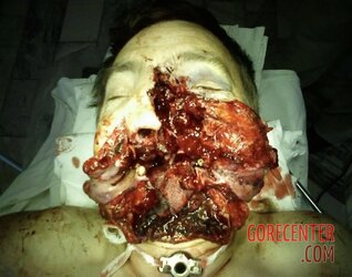 Facial-reconstruction-after-accident-1.jpg