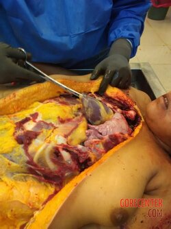 Autopsy-of-curvy-woman-9.jpg