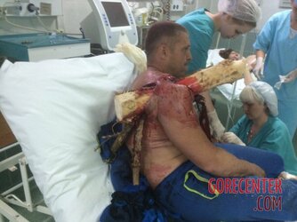 Pilots-shoulder-is-impaled-by-tree-branch-2.jpg