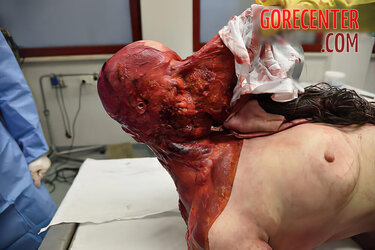 Skinned-woman-on-autopsy-table-3.jpg