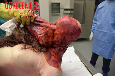 Skinned-woman-on-autopsy-table-4.jpg