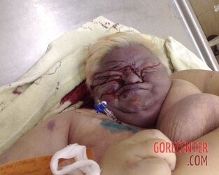 Morbidly-obese-woman-in-morgue-10.jpg