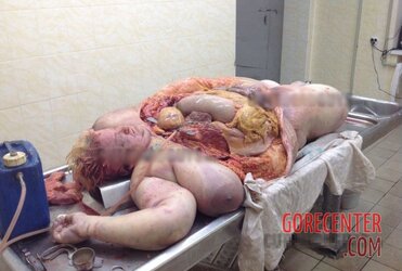 Morbidly-obese-woman-in-morgue-2.jpg