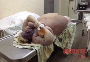 Morbidly-obese-woman-in-morgue-1.jpg