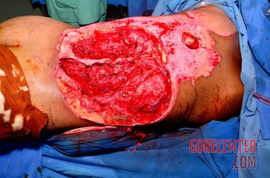 Extreme-electrical-burns-7.jpg