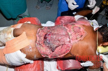 Extreme-electrical-burns-16.jpg