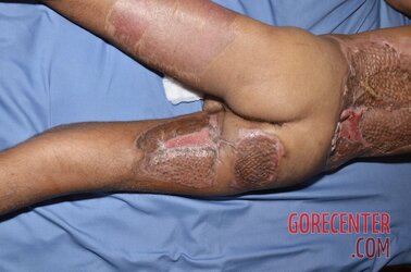 Extreme-electrical-burns-24.jpg