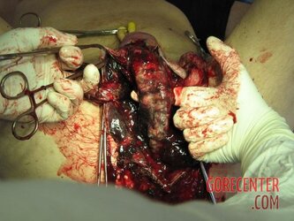 Necrosis-of-testicles-5.jpg