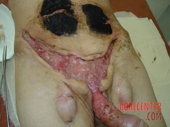 Necrosis-of-testicles-18.jpg