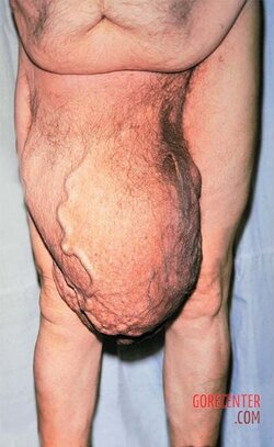 Large-right-inguinal-hernia-1.jpg