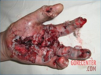 MIX-Hand-injuries-12.jpg