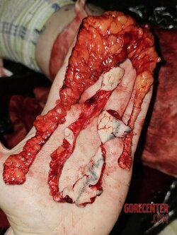 Extreme-self-harm-Skin-removal-2.jpg