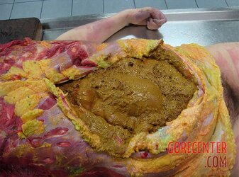 Ruptured-colon-caused-her-death-2.jpg