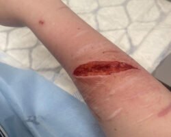 Teen-girl-cuts-so-deep-that-she-gets-stitches-1-250x200.jpg