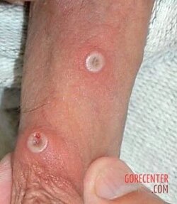 MIX_-People-infected-with-mpox-5.jpg