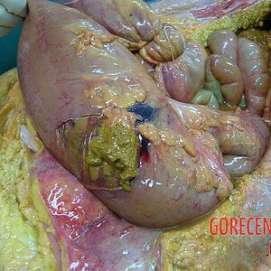 Ruptured-colon-caused-her-death-1.jpg