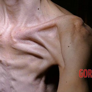 MIX-Extreme-cases-of-anorexia-19.jpg