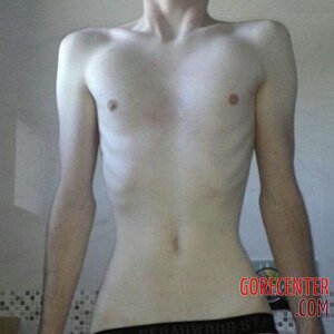 MIX-Extreme-cases-of-anorexia-46.jpg