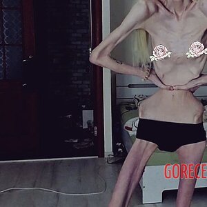 MIX-Extreme-cases-of-anorexia-43.jpg