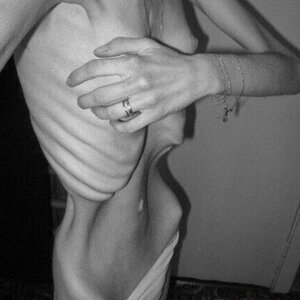 MIX-Extreme-cases-of-anorexia-34.jpg