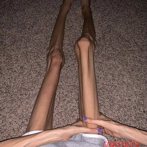 MIX-Extreme-cases-of-anorexia-33.jpg