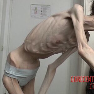 MIX-Extreme-cases-of-anorexia-28.jpg